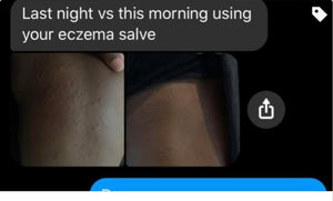 Eczema Salve